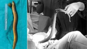জেলের পায়ুপথে ঢুকে পড়া জ্যান্ত বাইম মাছ বের করার বিরল ঘটনা বিজ্ঞান সাময়িকীতে