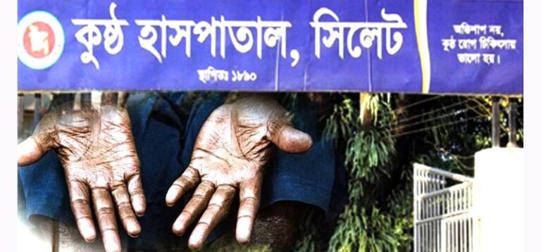 <span style='color:#000;font-size:18px;'>আলোচনা সভায় তথ্য প্রকাশ</span><br/> সিলেটে জেলায় এক বছরে ১১১ কুষ্ঠ রোগী শনাক্ত