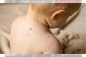 সিলেটে হামের উপসর্গ নিয়ে আরেক শিশুর মৃত্যু